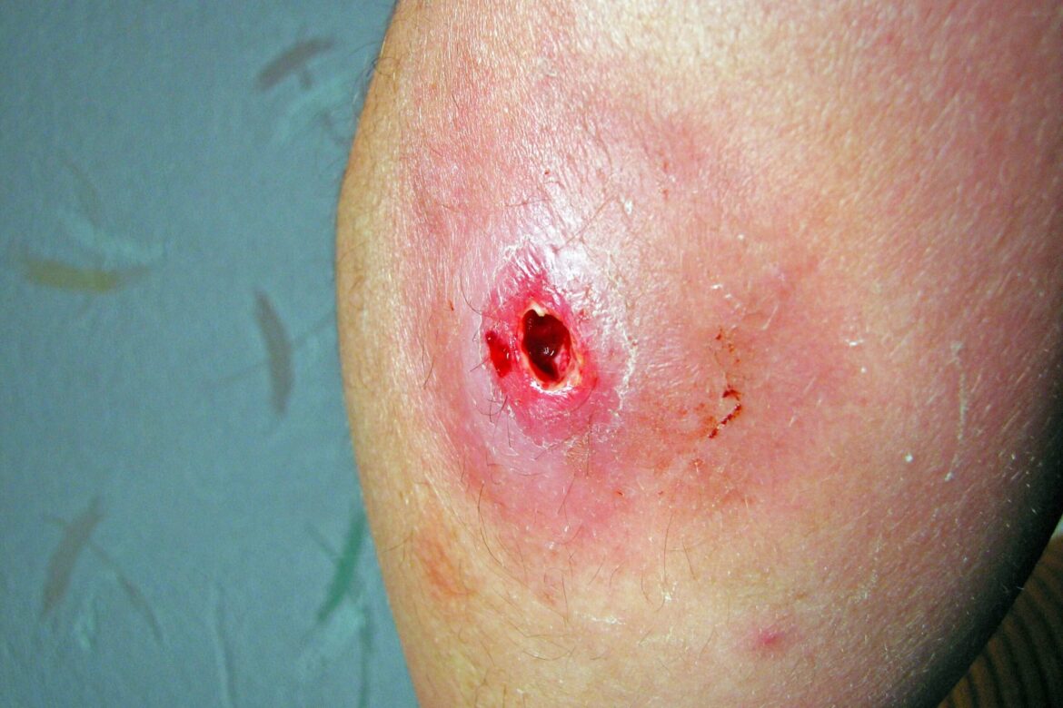 How Long Does A Tunneling Wound Take To Heal: Insights & Timeline